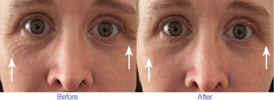 2 Minute Cream Before and After Testimonial 2