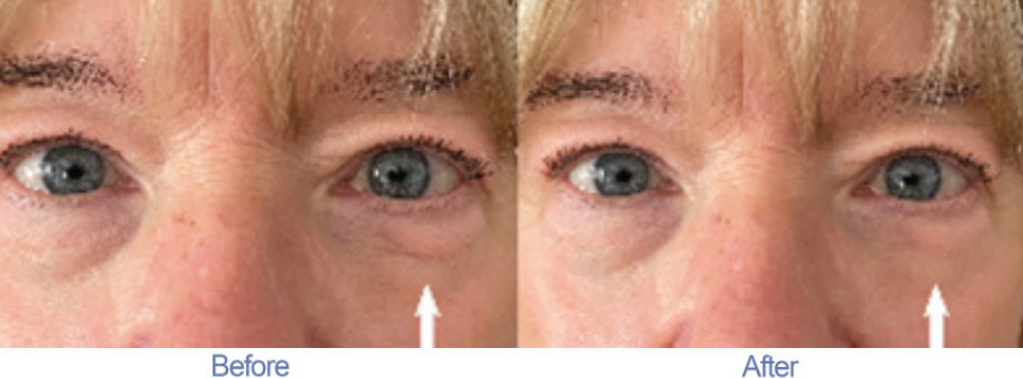 2 Minute Cream Before and After Testimonial 5